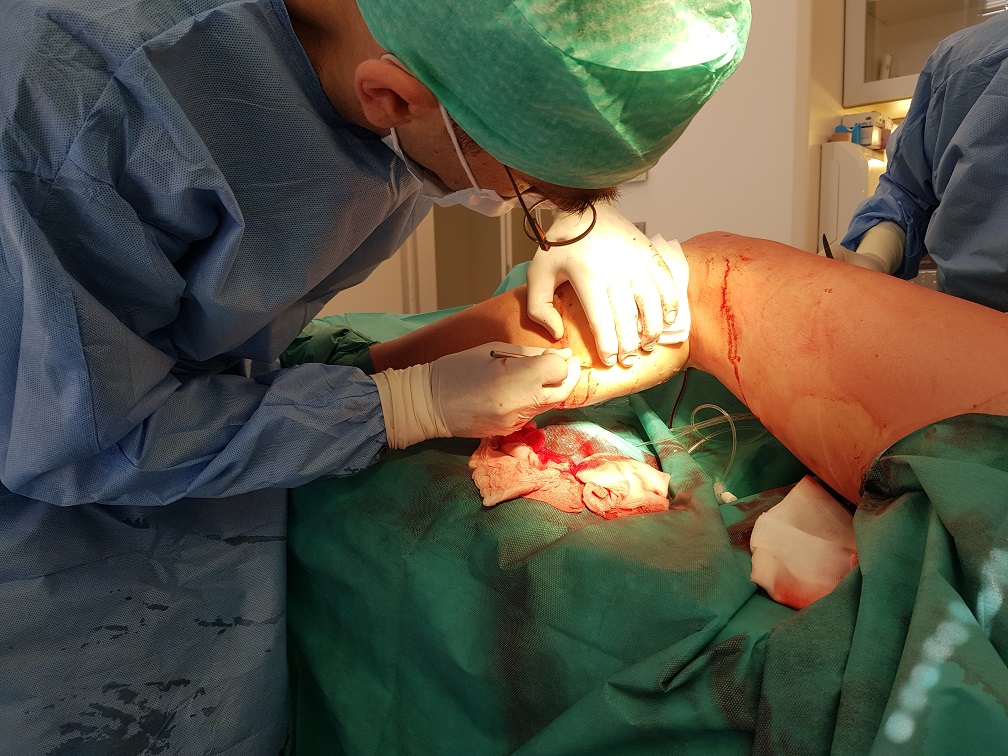 Operater Matej Makovec operira krčne žile, opravlja flebektomijo na goleni.